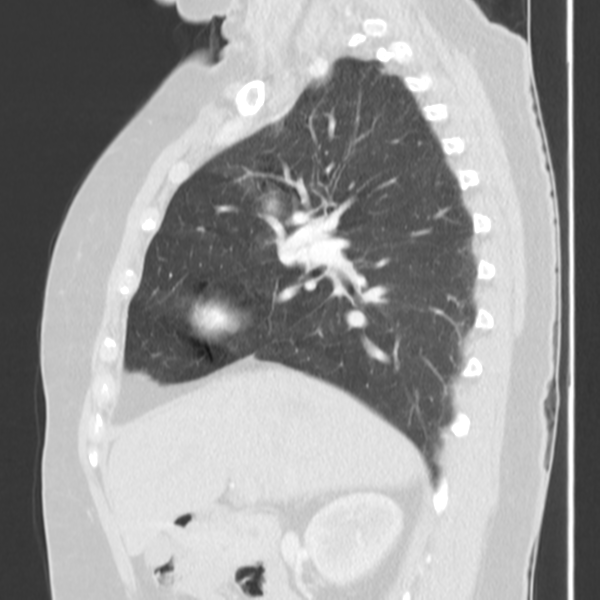 Obstructing typical carcinoid causing bronchoceles (Radiopaedia 50149-55476 Sagittal lung window 22).png