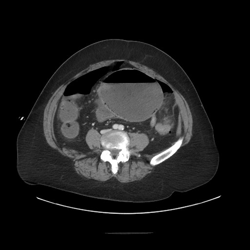 Obstructive distal colonic adenocarcinoma causing cecal perforation (Radiopaedia 86830-102989 A 127).jpg