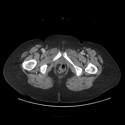 Obstructive distal colonic adenocarcinoma causing cecal perforation (Radiopaedia 86830-102989 A 197).jpg