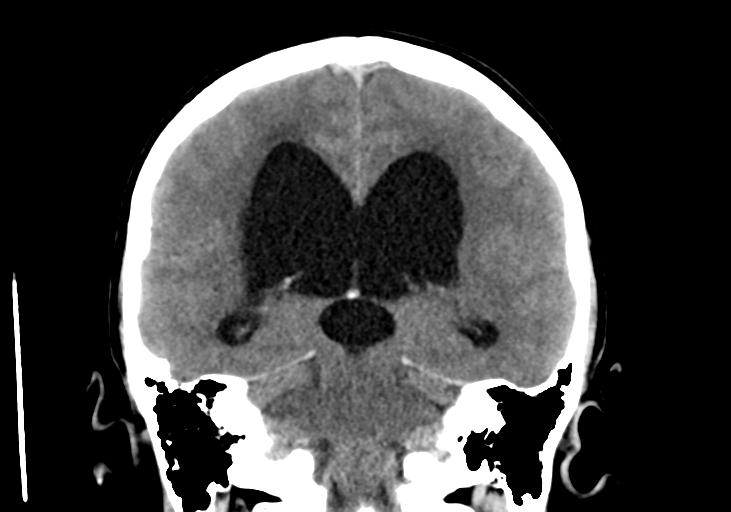 File:Obstructive hydrocephalus (Radiopaedia 30453-31119 Coronal non-contrast 24).jpg