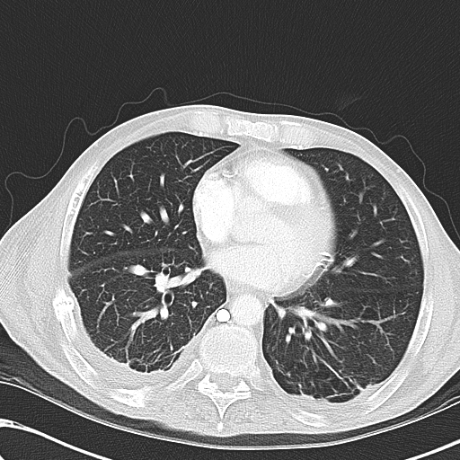 File:Obstructive superior vena cava tumor thrombus (Radiopaedia 28046-28306 Axial lung window 34).jpg