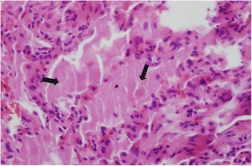 Pulmonary alveolar proteinosis high magnification photomicrograph showing complete filling of alveoli with periodic-acid-Schiff-positive granular materia