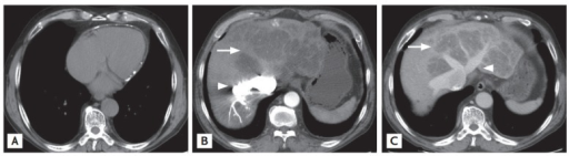 a) Sparse pericardial calcification with eccentric wall thickening b,c) liver CT shows variable regions of low attenuation, often called the “nutmeg liver” arrows