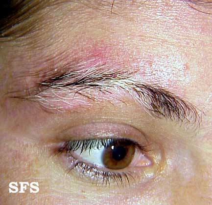 File:Vitiligo (Dermatology Atlas 8).jpg
