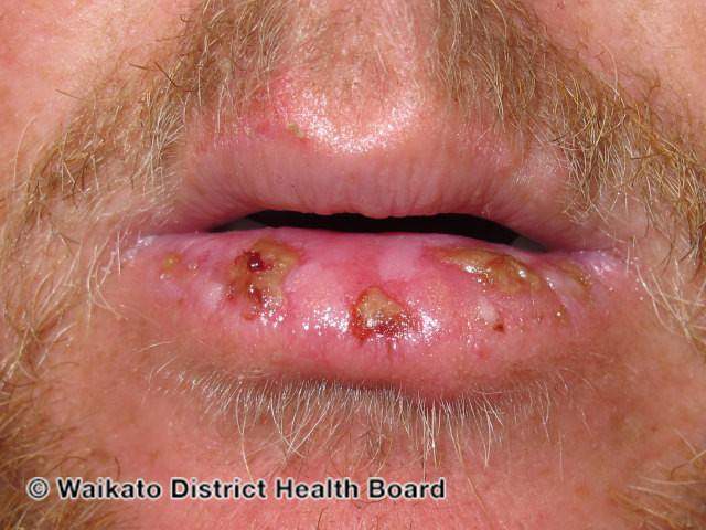 File:(DermNet NZ herpes-simplex-labialis-40).jpg