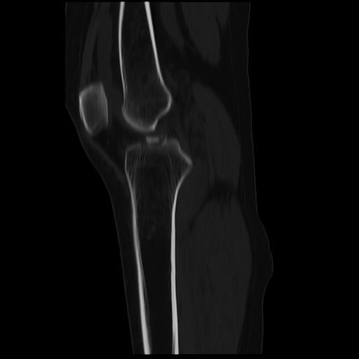 File:ACL avulsion fracture (Radiopaedia 33833-34994 Sagittal bone window 24).jpg
