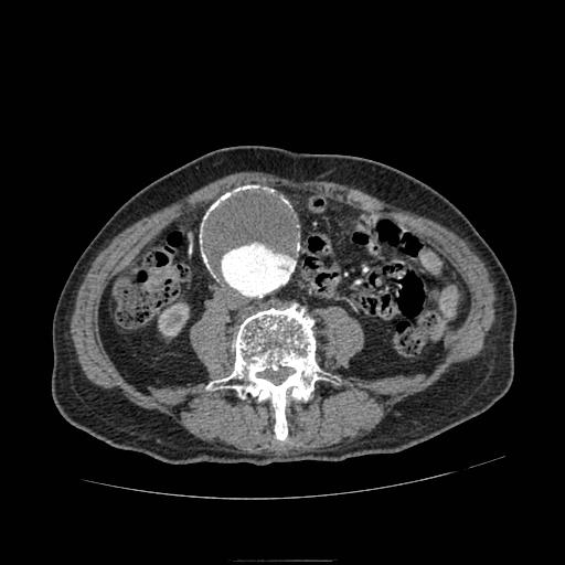 Abdominal aortic aneurysm (Radiopaedia 13341-13340 Axial C+ arterial phase 122).jpg