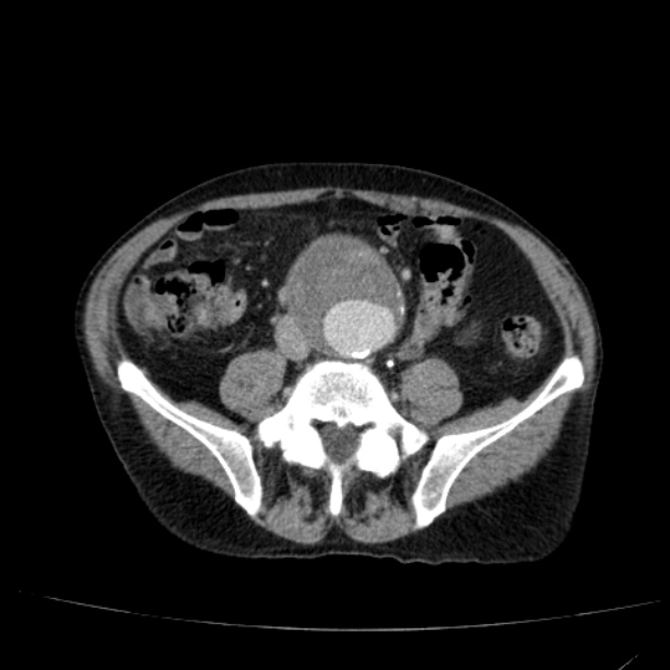 Abdominal aortic aneurysm (Radiopaedia 29248-29660 Axial C+ portal venous phase 40).jpg