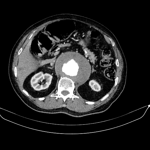 File:Abdominal aortic aneurysm (Radiopaedia 67117-76452 Axial C+ arterial phase 45).jpg