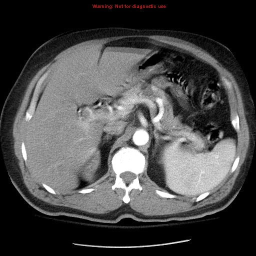 Abdominal aortic aneurysm (Radiopaedia 8190-9038 Axial C+ arterial phase 25).jpg
