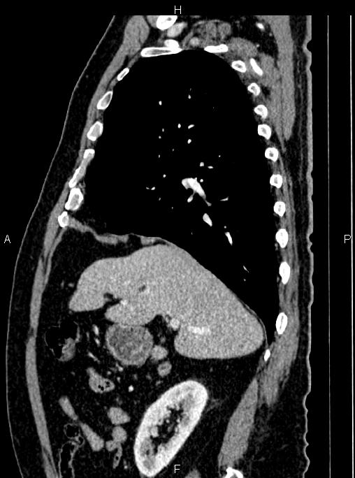 Abdominal aortic aneurysm (Radiopaedia 83094-97462 Sagittal renal cortical phase 42).jpg