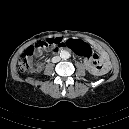 Abdominal aortic aneurysm (Radiopaedia 83581-98689 Axial C+ portal venous phase 66).jpg