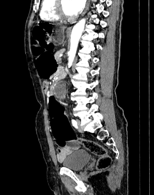 Abdominal aortic aneurysm (Radiopaedia 83581-98689 Sagittal C+ arterial phase 59).jpg