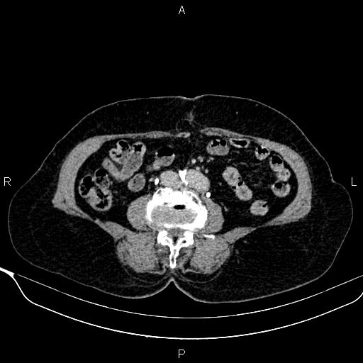 Abdominal aortic aneurysm (Radiopaedia 85063-100606 Axial C+ delayed 75).jpg