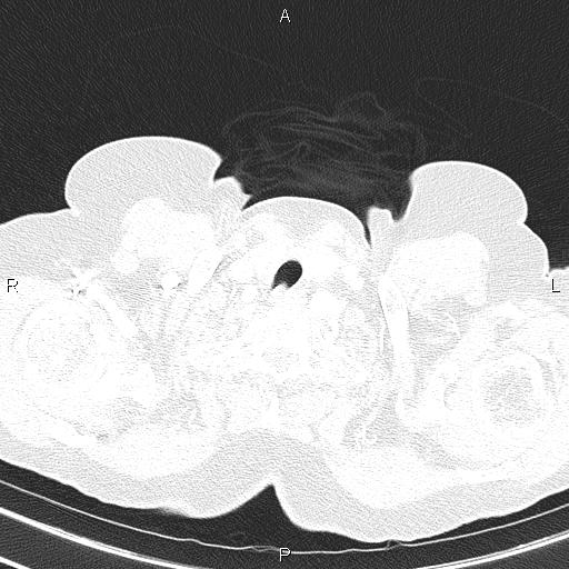 Abdominal aortic aneurysm (Radiopaedia 85063-100606 Axial lung window 8).jpg