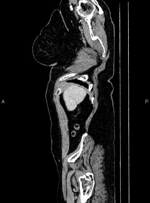Abdominal aortic aneurysm (Radiopaedia 85063-100606 Sagittal C+ arterial phase 4).jpg