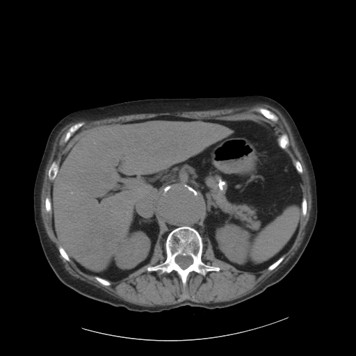 File:Abdominal aortic aneurysm (incidental finding on renal scintigraphy) (Radiopaedia 23997-24196 Axial 1).jpg