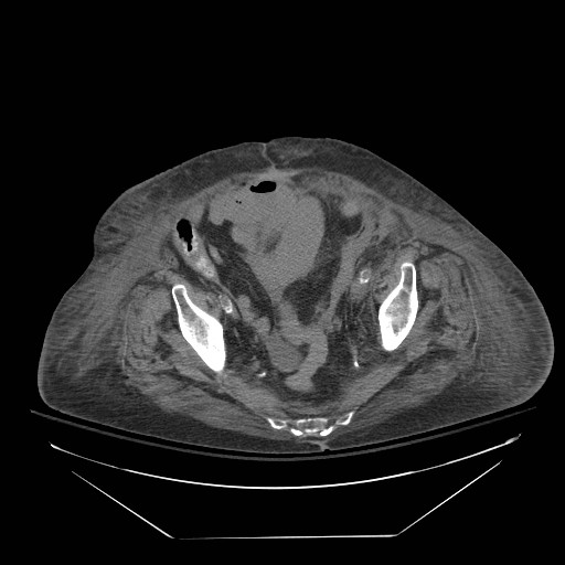 Abdominal aortic aneurysm - impending rupture (Radiopaedia 19233-19247 Axial non-contrast 139).jpg