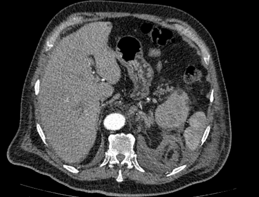 Abdominal aortic aneurysm rupture (Radiopaedia 54179-60362 Axial C+ arterial phase 22).jpg