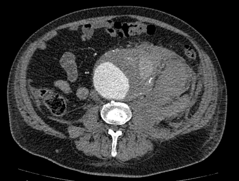 Abdominal aortic aneurysm rupture (Radiopaedia 54179-60362 Axial C+ arterial phase 36).jpg