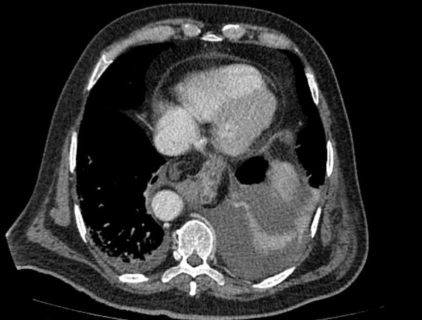 Abdominal aortic aneurysm rupture (Radiopaedia 54179-60362 Axial C+ portal venous phase 36).jpg