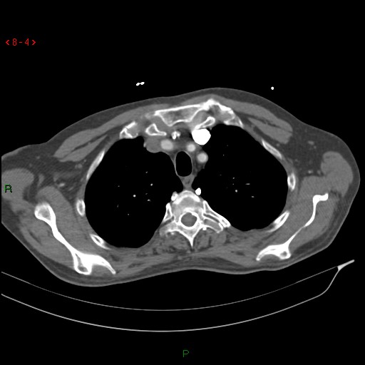 Abdominal aortic aneurysm rupture with aortocaval fistula (Radiopaedia 14897-14841 Axial C+ arterial phase 4).jpg
