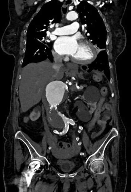 Abdominal aortic aneurysm with thrombus fissuration (Radiopaedia 73192-83919 Coronal C+ arterial phase 38).jpg