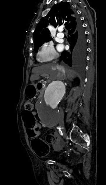 Abdominal aortic aneurysm with thrombus fissuration (Radiopaedia 73192-83919 Sagittal C+ arterial phase 85).jpg