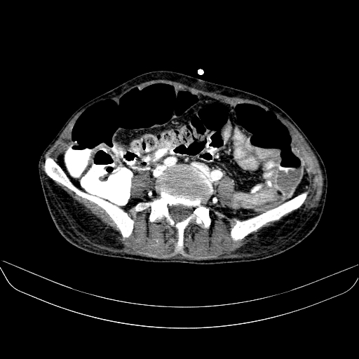 File:Abdominal collection due to previous cecal perforation (Radiopaedia 80831-94320 Axial C+ portal venous phase 130).jpg