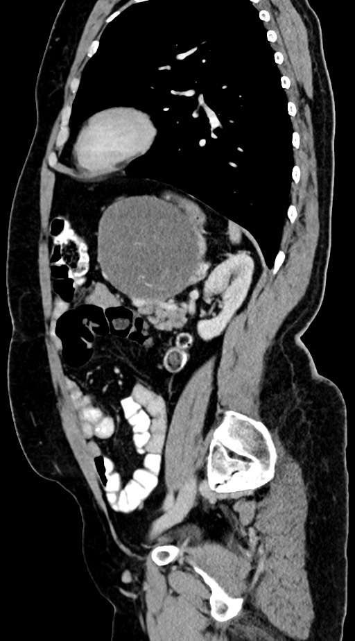 Abdominal hydatid disease (Radiopaedia 68223-77737 Sagittal C+ portal venous phase 23).jpg