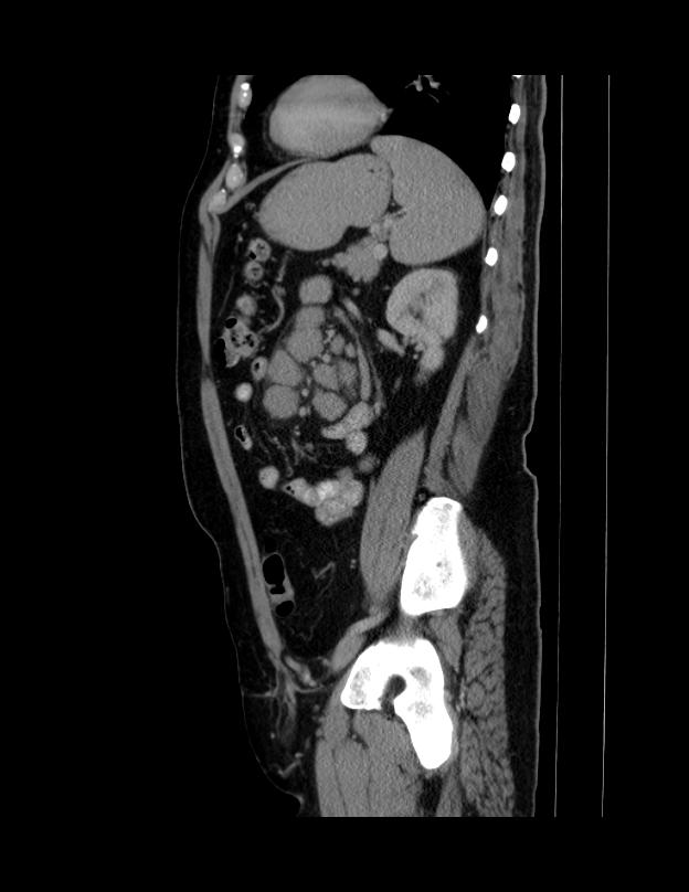 Abdominal lymphoma - with sandwich sign (Radiopaedia 53486-59492 Sagittal C+ portal venous phase 24).jpg