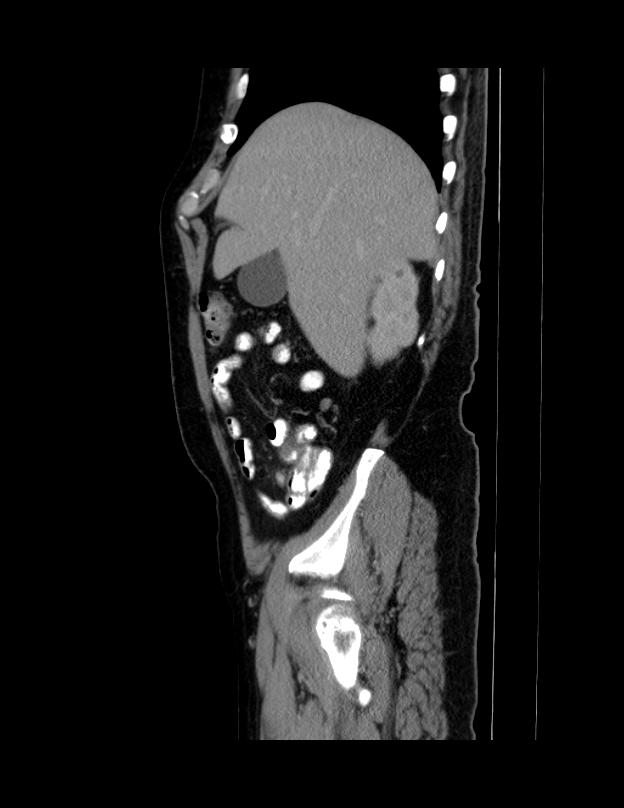 Abdominal lymphoma - with sandwich sign (Radiopaedia 53486-59492 Sagittal C+ portal venous phase 63).jpg