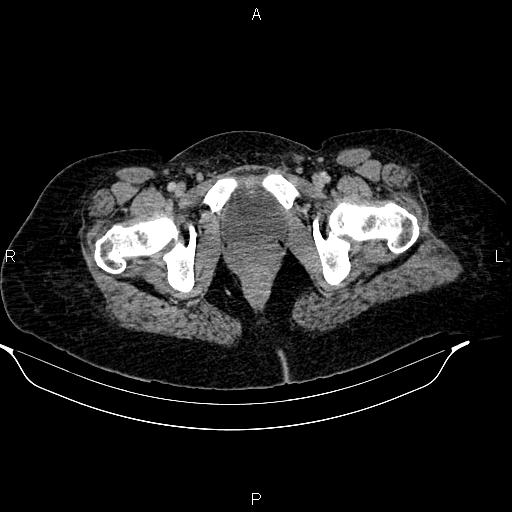 Abdominal lymphoma with sandwich sign (Radiopaedia 84378-99704 Axial C+ portal venous phase 58).jpg