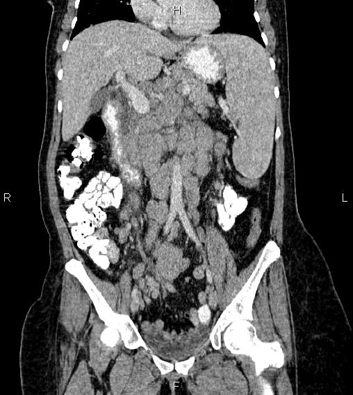 Abdominal lymphoma with sandwich sign (Radiopaedia 84378-99704 Coronal C+ portal venous phase 27).jpg