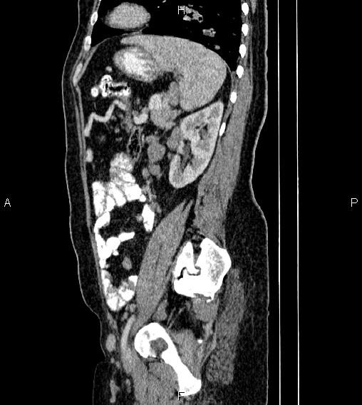 Abdominal lymphoma with sandwich sign (Radiopaedia 84378-99704 Sagittal C+ portal venous phase 67).jpg