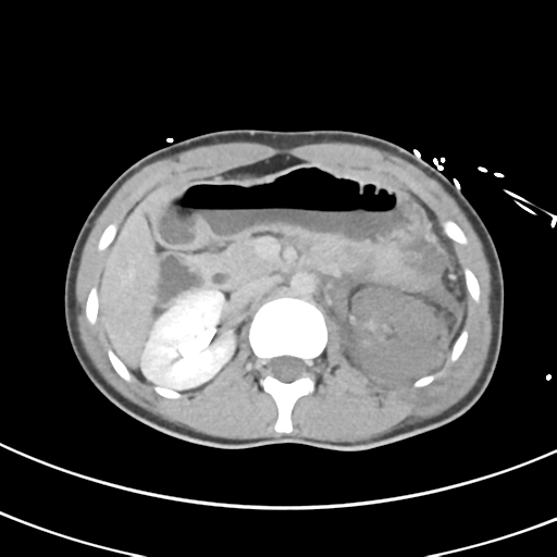 File:Abdominal multi-trauma - devascularised kidney and liver, spleen and pancreatic lacerations (Radiopaedia 34984-36486 Axial C+ delayed 28).png