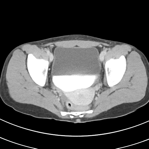 File:Abdominal multi-trauma - devascularised kidney and liver, spleen and pancreatic lacerations (Radiopaedia 34984-36486 Axial C+ delayed 71).png