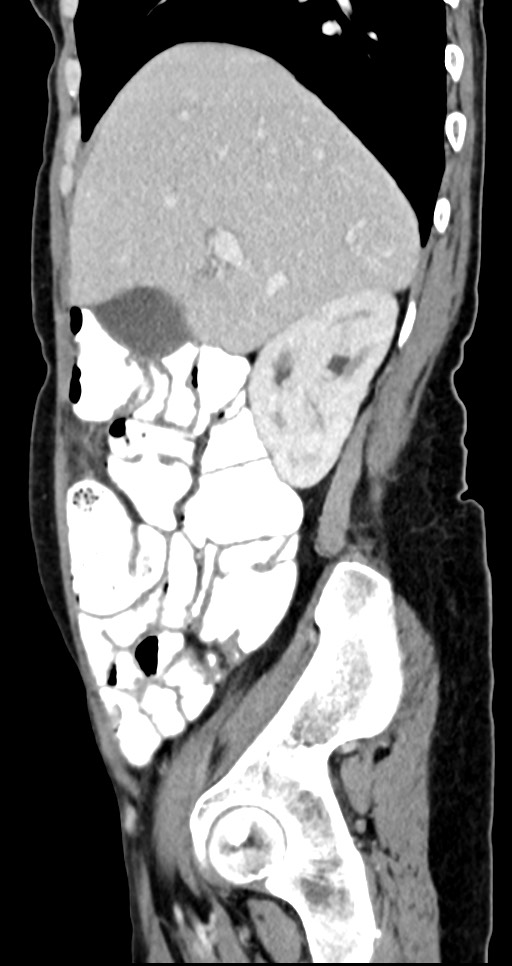 Abdominal wall and retroperitoneal tuberculosis (Radiopaedia 88137-104729 Sagittal C+ portal venous phase 108).jpg