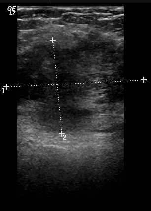 File:Abdominal wall endometriosis (Radiopaedia 25723-25886 A 2).jpg