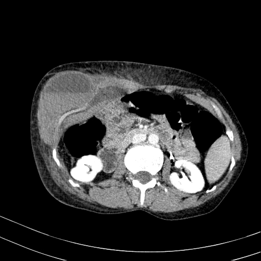 Abdominal wall hematoma with active bleeding (Radiopaedia 83915-99117 Axial C+ portal venous phase 30).jpg
