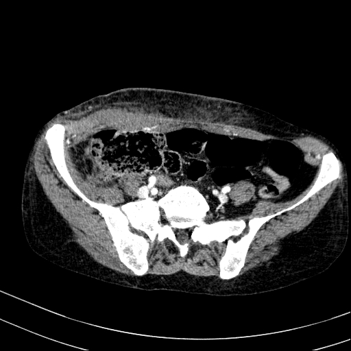 Abdominal wall hematoma with active bleeding (Radiopaedia 83915-99117 Axial renal cortical phase 94).jpg