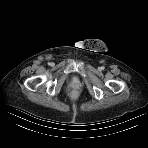 File:Abdominal wall recurrence after colorectal resection for cancer (Radiopaedia 23444-23523 Axial C+ portal venous phase 41).jpg