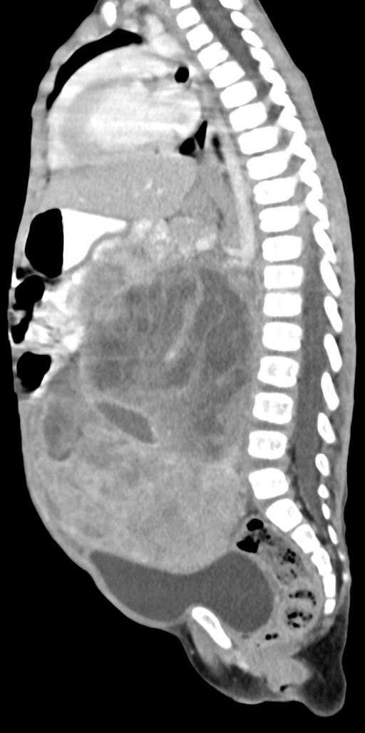 Abdominopelvic rhabdomyosarcoma (Radiopaedia 78356-90984 Sagittal C+ portal venous phase 45).jpg