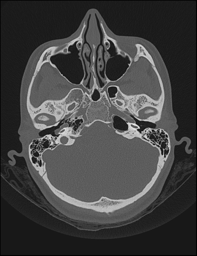 Aberrant right internal carotid artery (Radiopaedia 65191-74198 Axial non-contrast 38).jpg