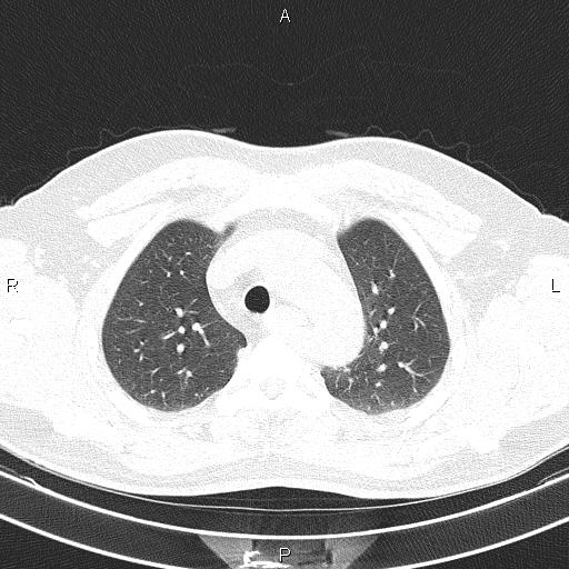 Aberrant right subclavian artery (Radiopaedia 87093-103354 Axial lung window 28).jpg