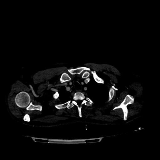 Accesory rib joint (Radiopaedia 71987-82452 Axial bone window 87).jpg