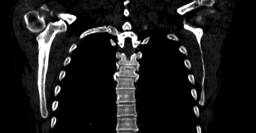 Accesory rib joint (Radiopaedia 71987-82452 Coronal bone window 43).jpg