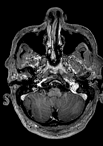 Accessory middle cerebral artery (Radiopaedia 73114-83828 Axial T1 C+ 152).jpg