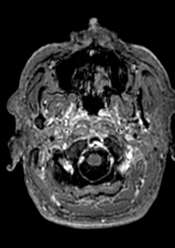 Accessory middle cerebral artery (Radiopaedia 73114-83828 Axial T1 C+ 191).jpg