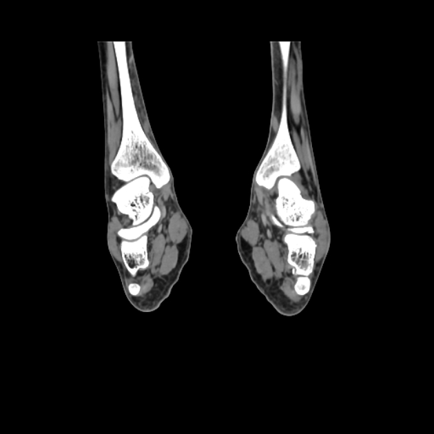 Accessory soleus muscle (Radiopaedia 61069-68943 Coronal non-contrast 38).jpg
